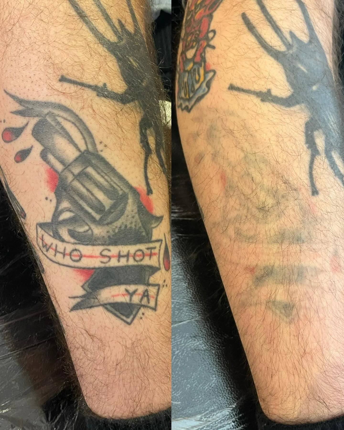 Making space for something new
.
.
.
#tattooremovalnewcastle #tattooremovalwhitleybay #lasertattooremovalnewcastle