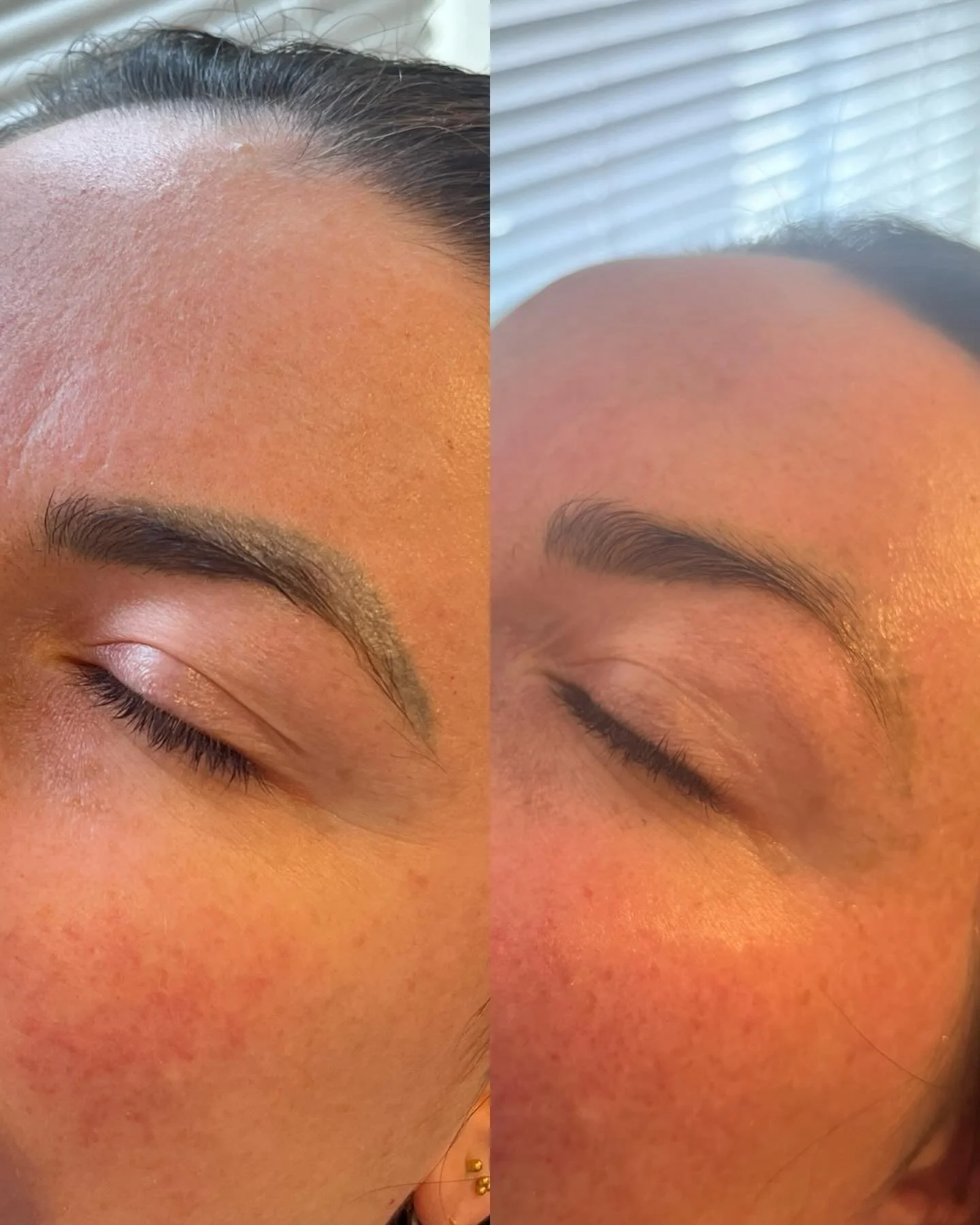 Tattooed eyebrow removal. Results after 1 session with an 8 week healing period before the 2nd.