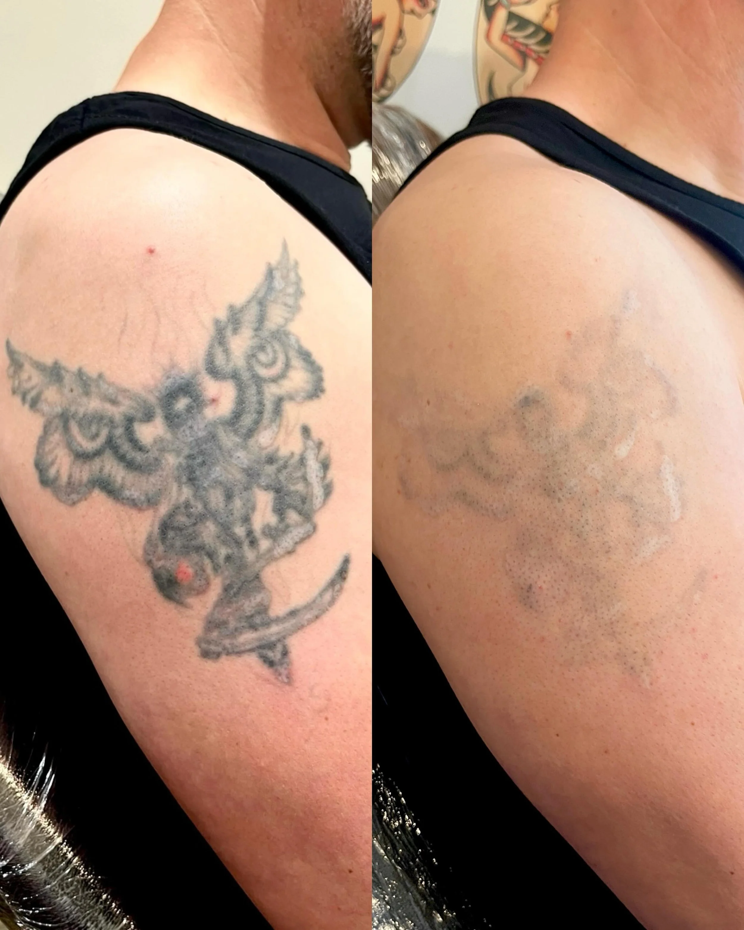 Amazing results and now this one&rsquo;s cover up ready. Looking forward to seeing the fresh tattoo over the top.

The scarring is from a home made DIY removal attempt before his consultation with me. Pretty mad but I appreciate the effort 😂
