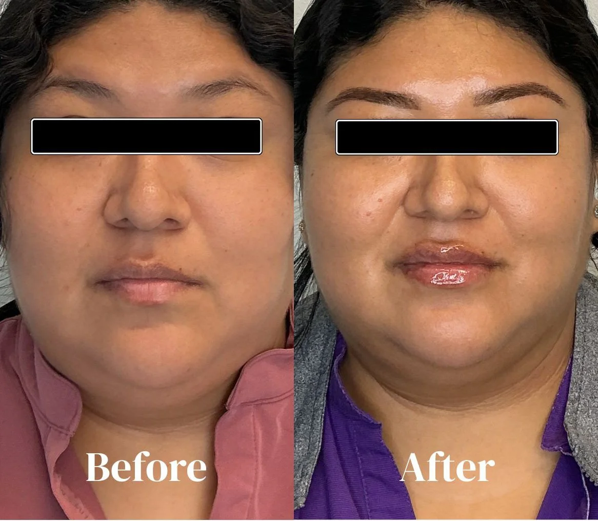 Lip filler 3.jpg