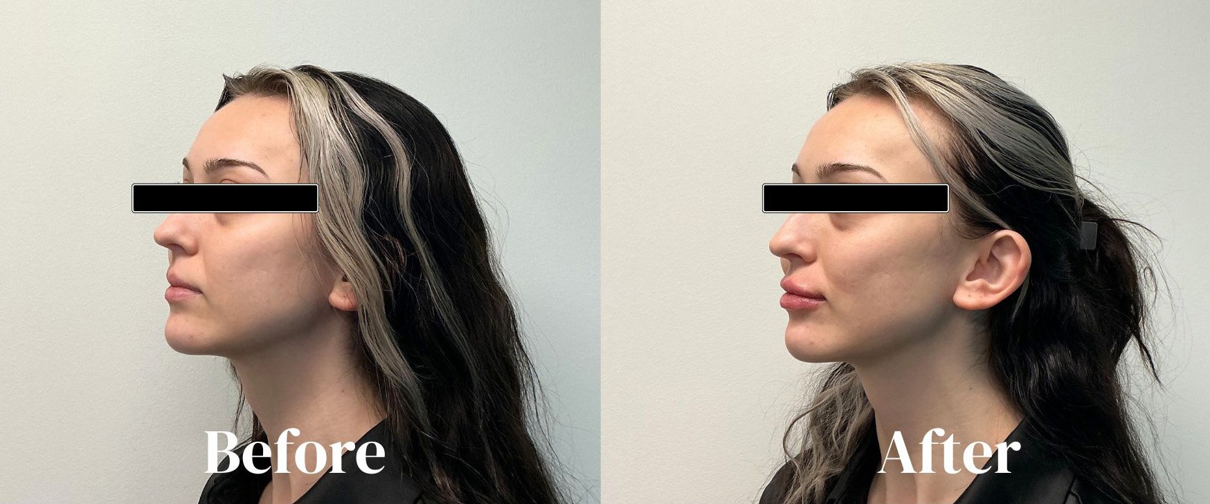 Lip Filler.jpg