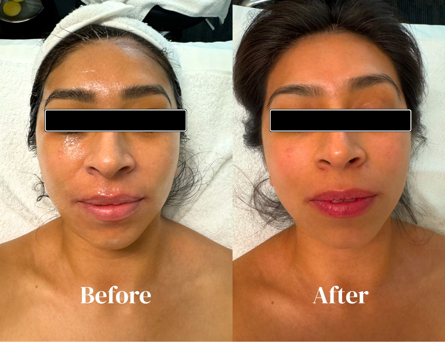 Microneedling Face.png