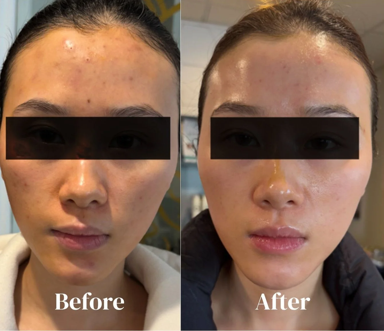 Chemical peel .jpg