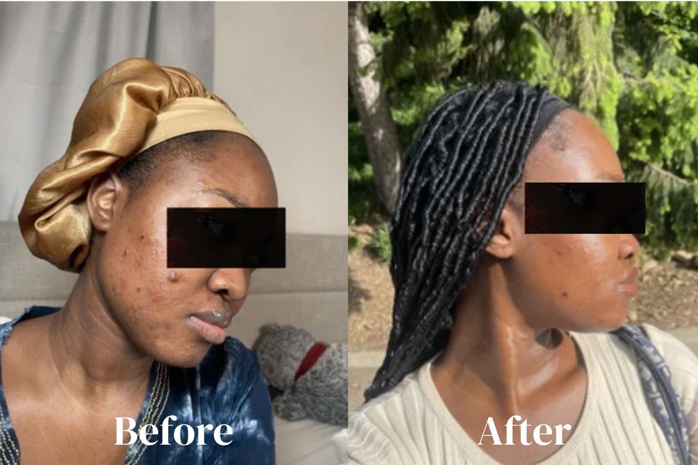 Chemical peels.jpg