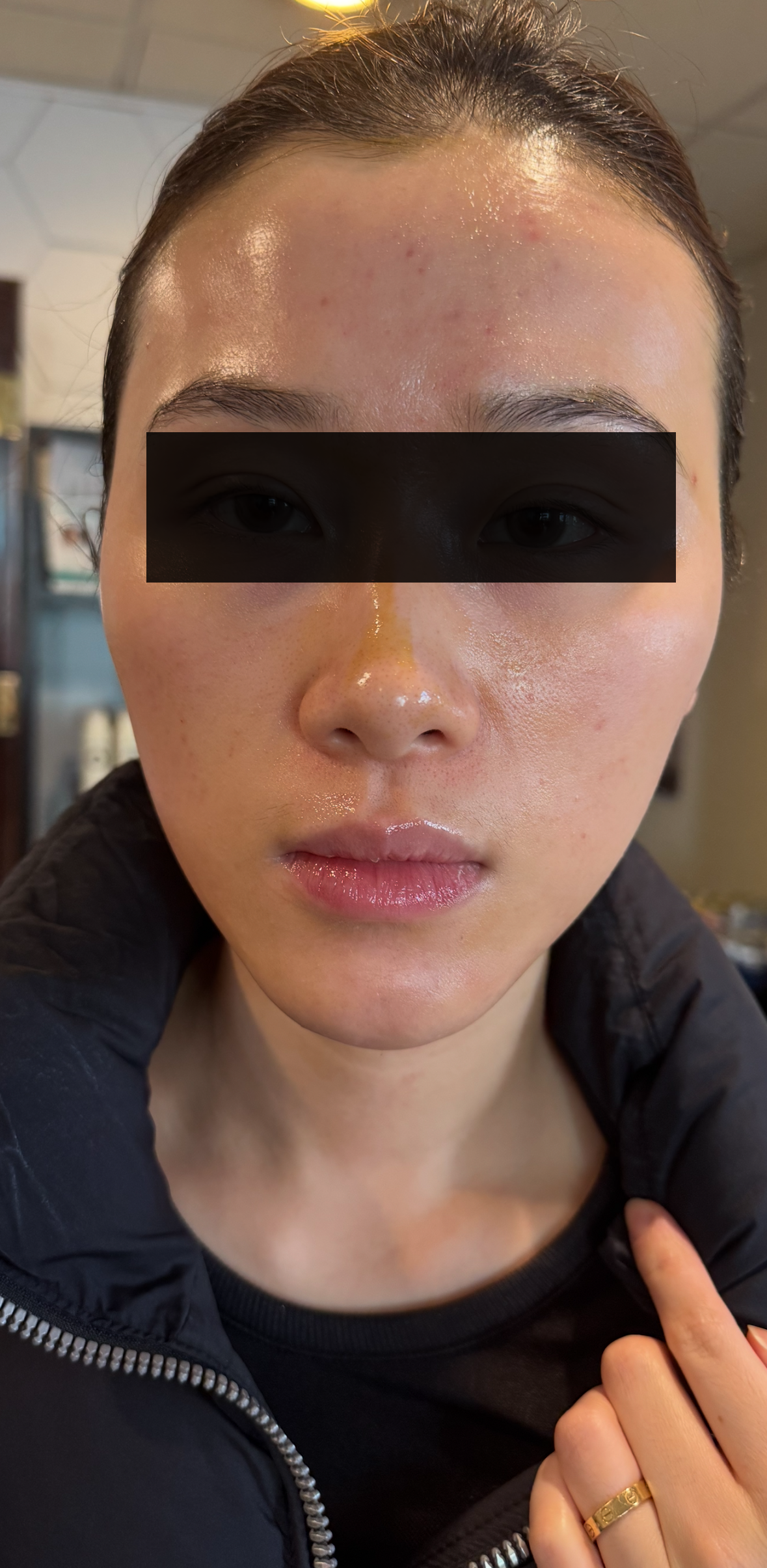 Chemical Peel - After