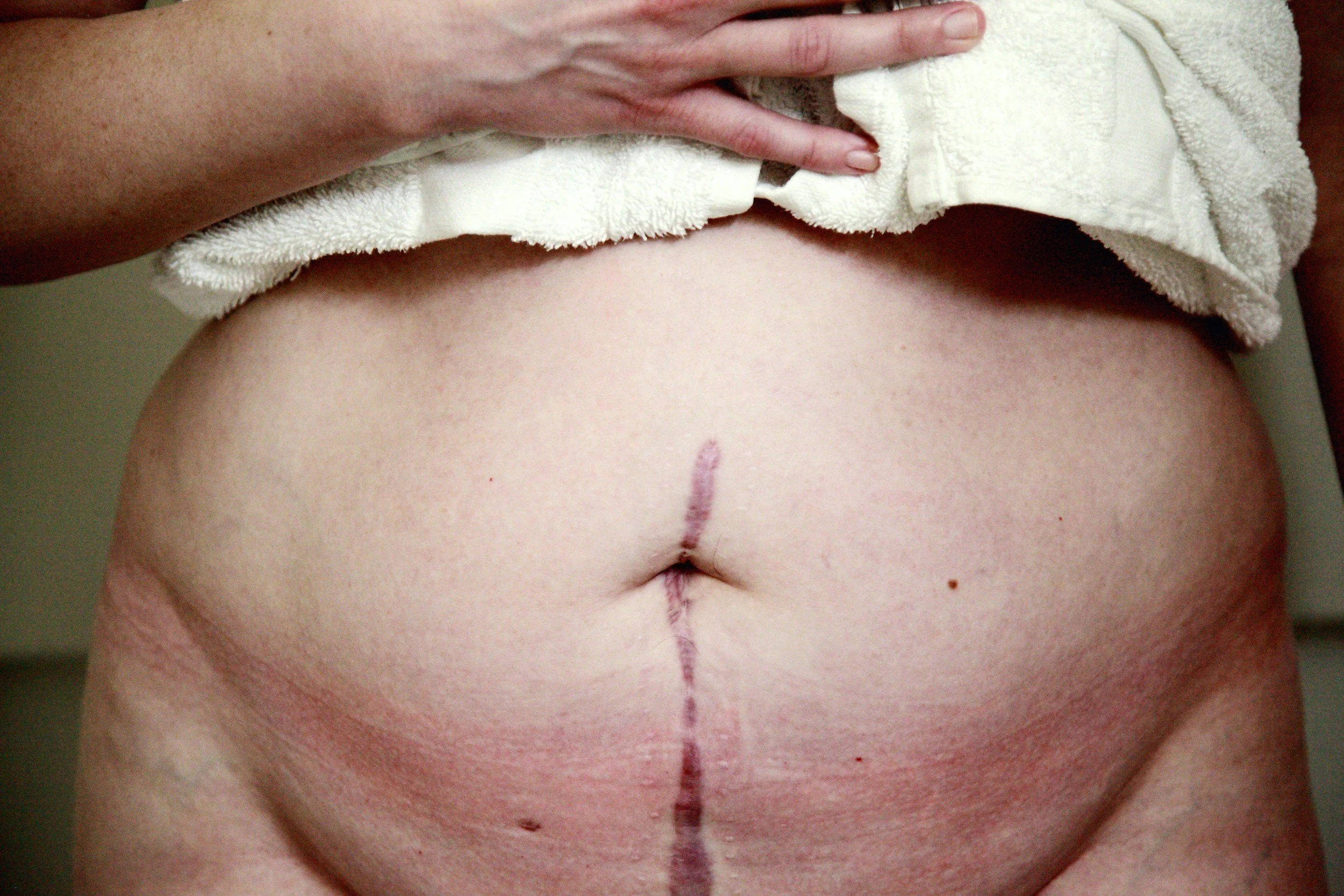 Close-up of a person's lower back with a vertical scar, partially covered by a towel and a hand resting on top.