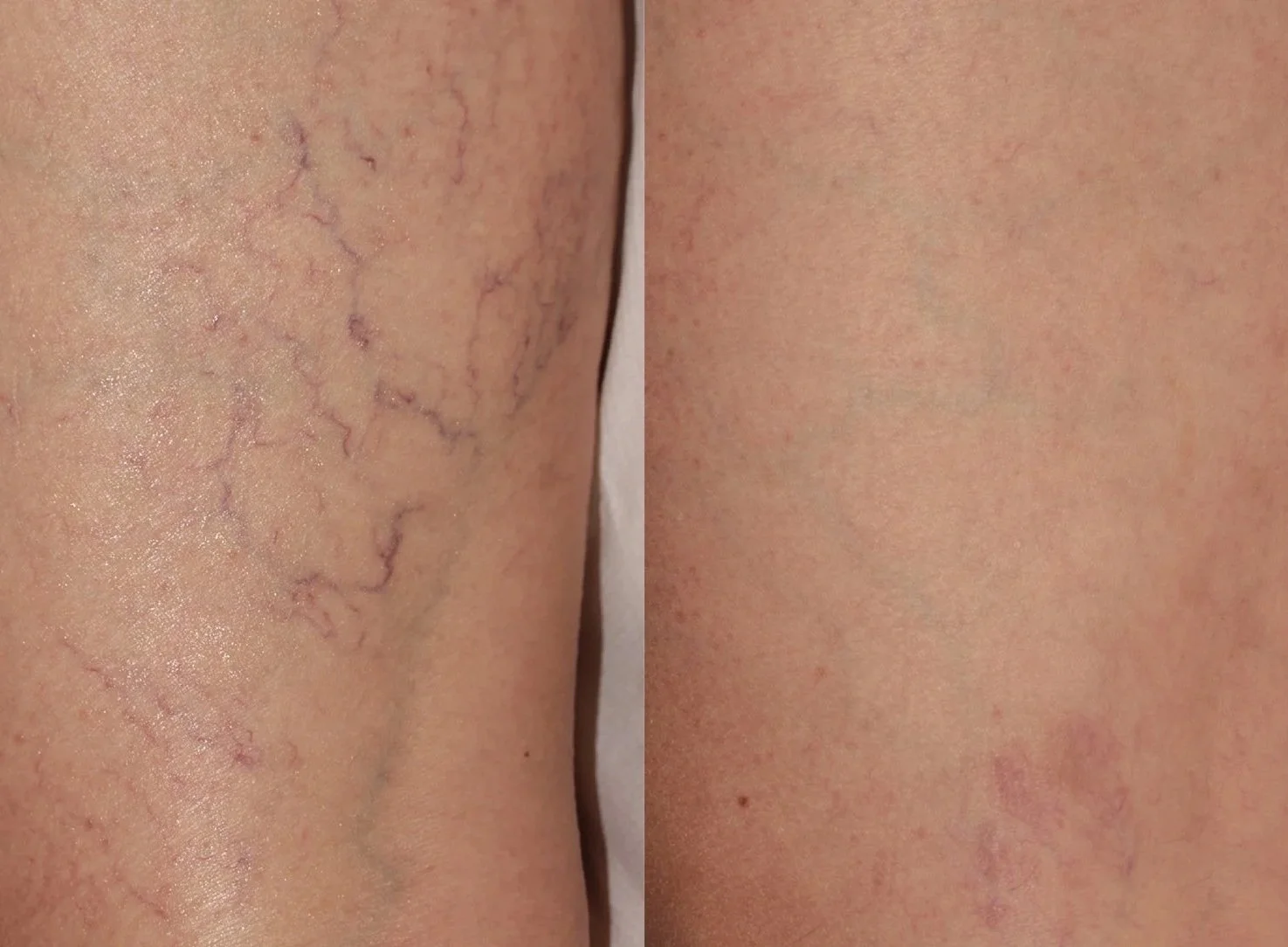Laser Spider Vein Treatment