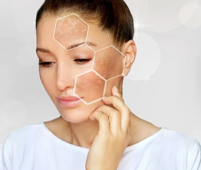 Pigmented Lesion Removal