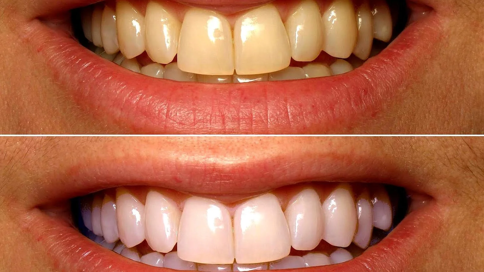Teeth Whitening