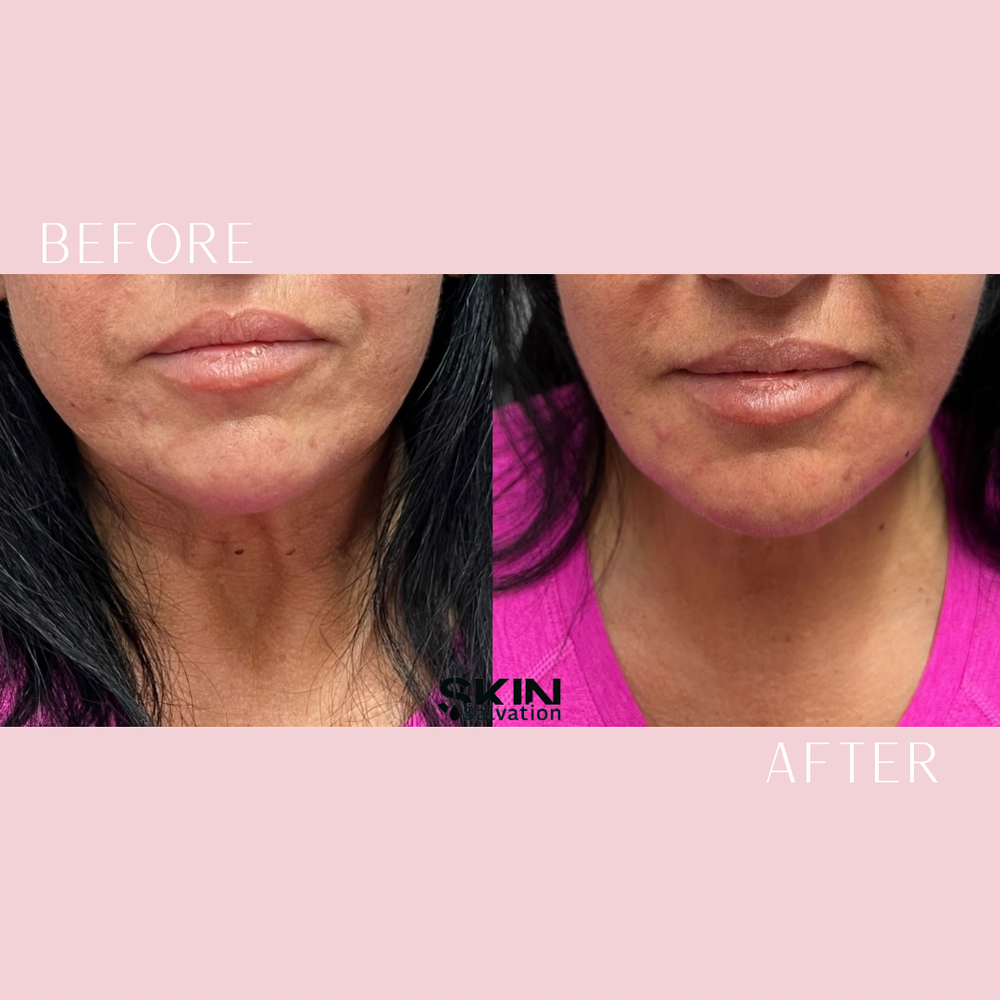 Biostimulator: Radiesse