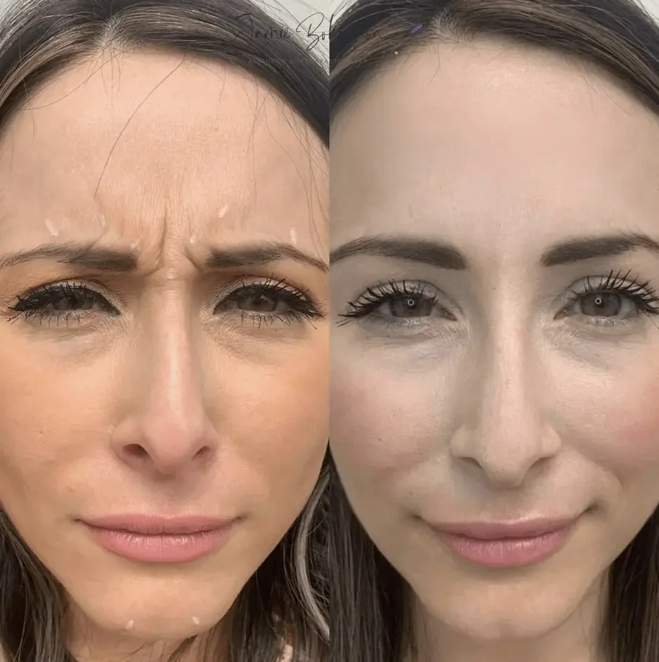 Botox