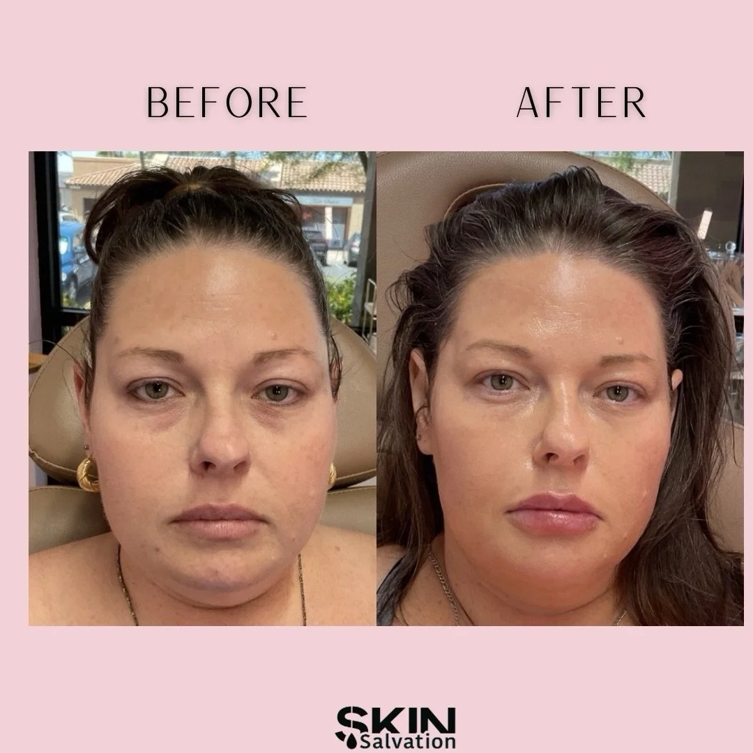 A few of our favorite before &amp; afters 🤍✨

Subtle tweaks. Strategic placement. Full facial harmony.
No overfilling. No &ldquo;done&rdquo; look. Just refreshed, confident, still-you energy.

At Skin Salvation&trade;, we don&rsquo;t chase trends, w