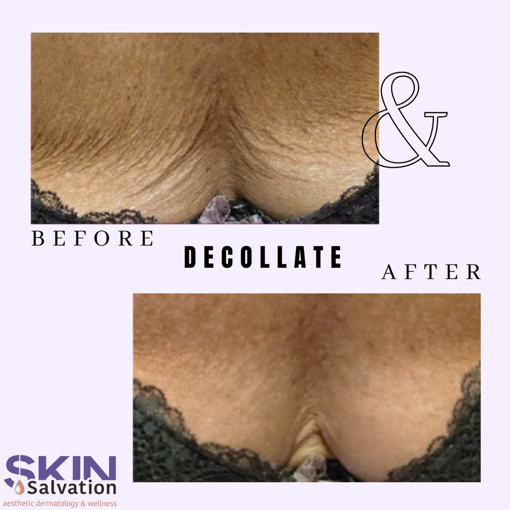 BioLift Decolletage