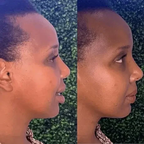 Kybella