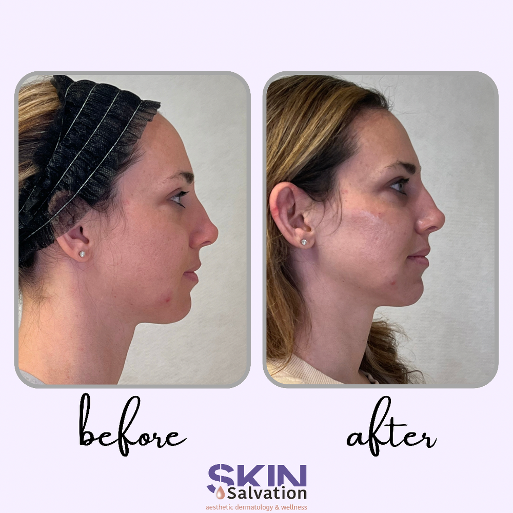 Sculptra: Chin, Cheeks, Nasolabial Folds