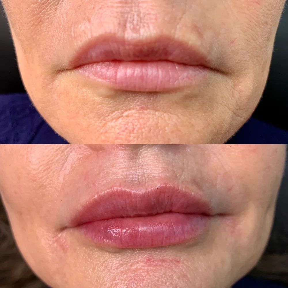 Filler: Lips
