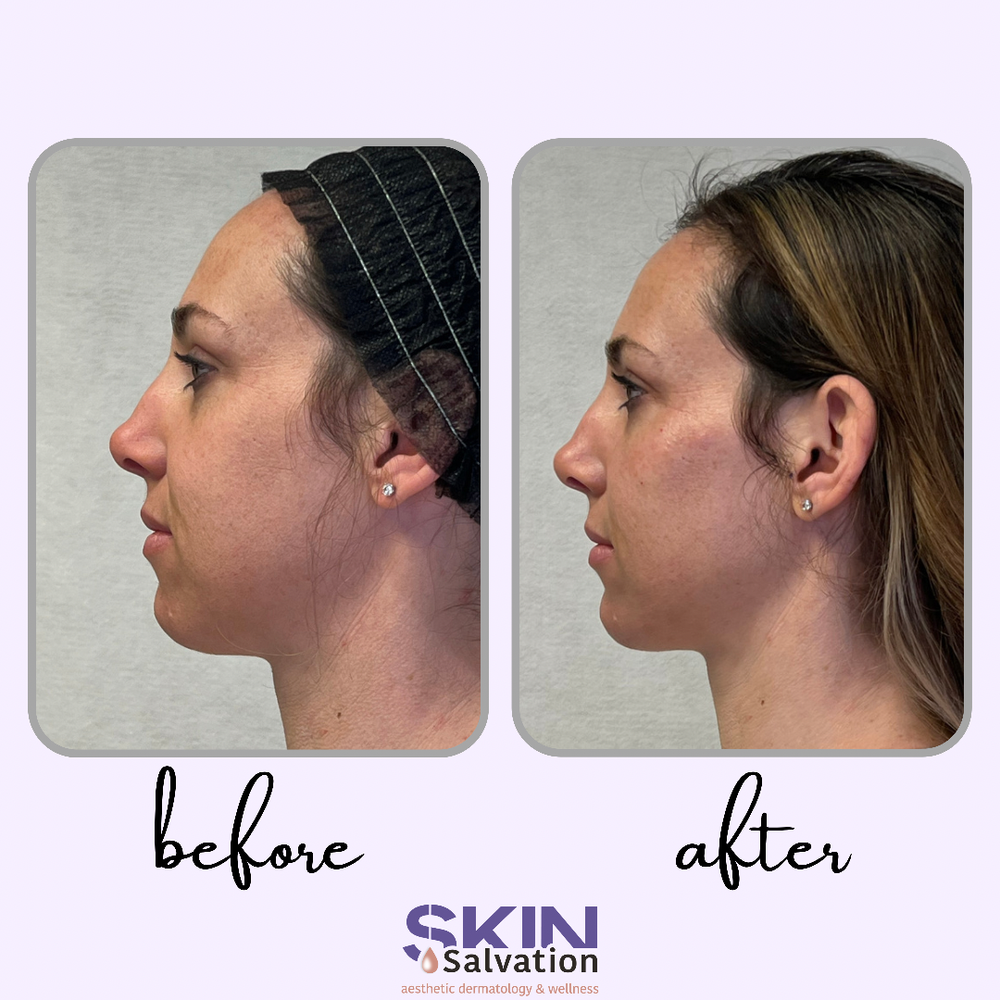 Sculptra: Chin, Cheeks, Nasolabial Folds