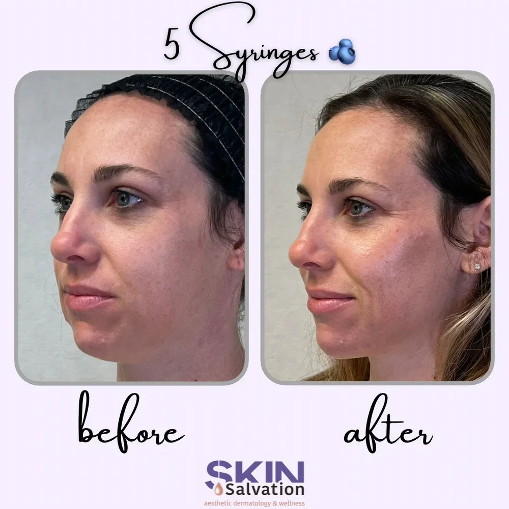 Sculptra: Chin, Cheeks, Nasolabial Folds