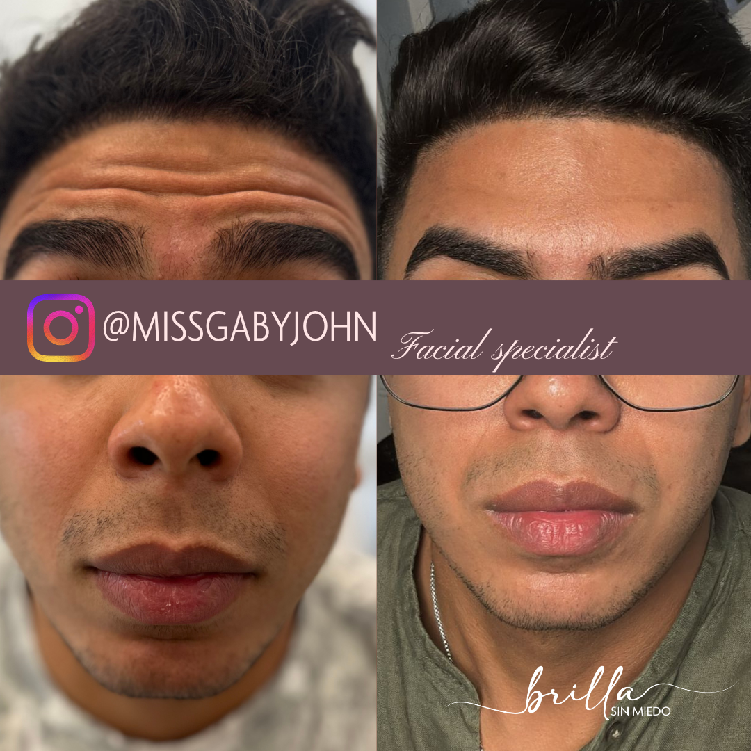 Botox 1.png