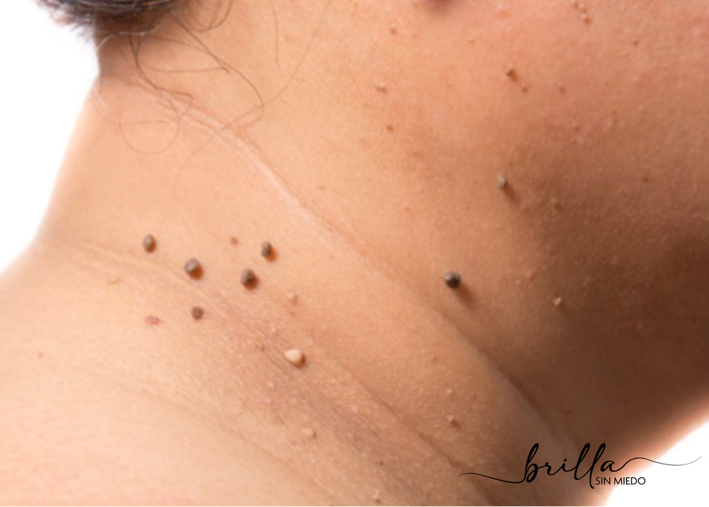 wart removal.webp