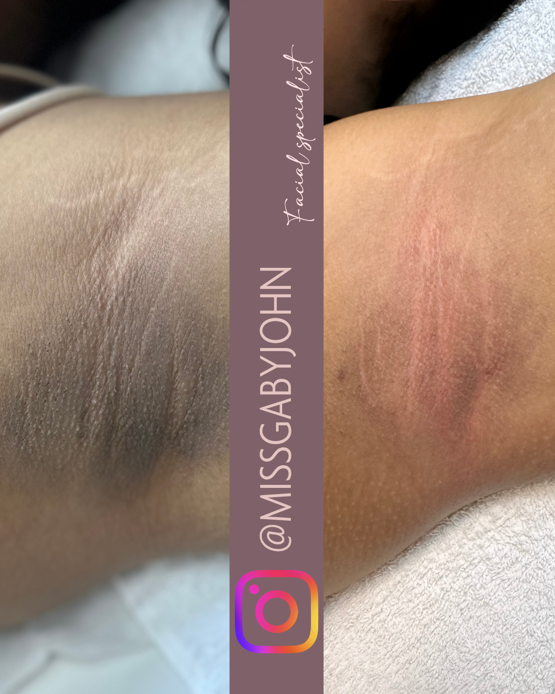 Underarm lightening