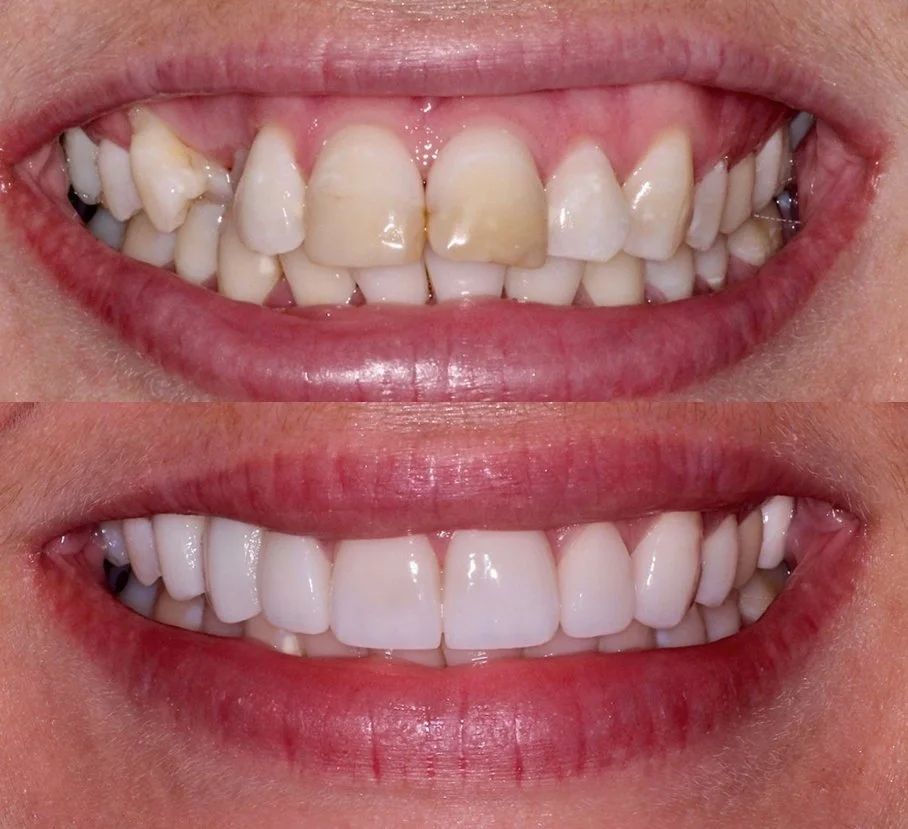 Comparison of teeth before and after dental treatment showing whiter, straighter teeth after whitening and orthodontics.