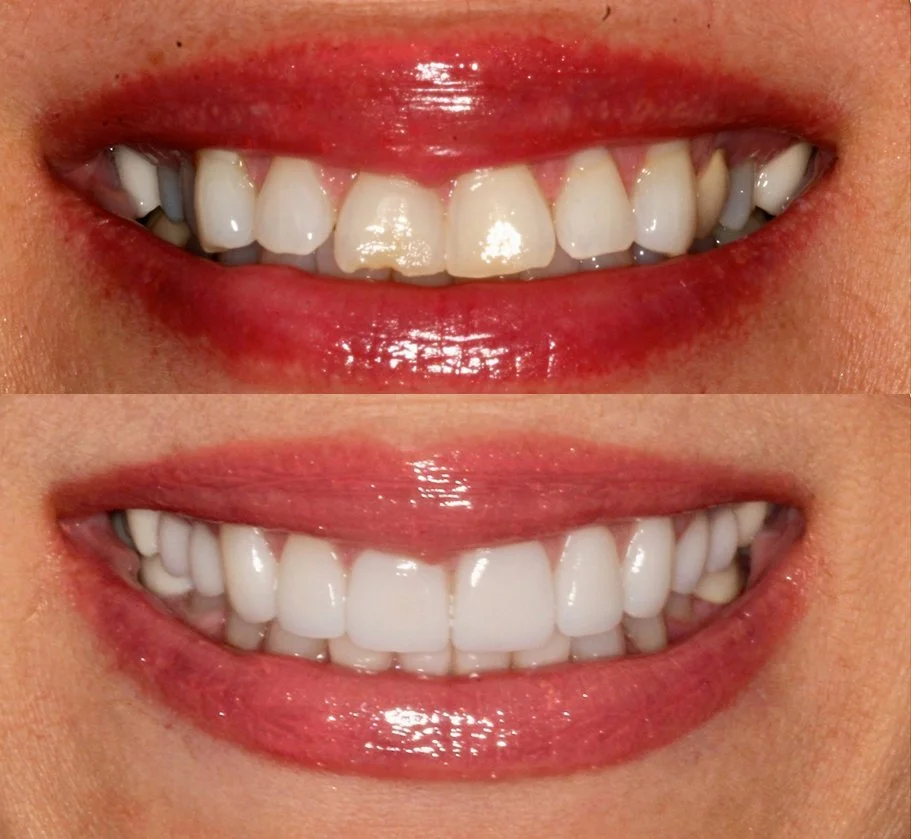 Comparison of teeth before and after dental treatment showing significant whitening and straightening improvements.
