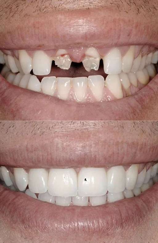 Comparison of two photos showing a person's smile: the top image displays broken, damaged, and missing teeth, while the bottom image shows a restored, even, and healthy set of teeth after dental treatment.