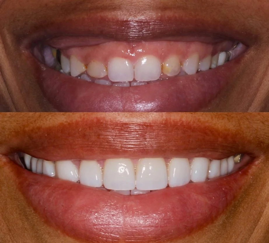 Before and after images of a person's smile showing dental improvements: the top image shows teeth with decay and discoloration, while the bottom image shows cleaner, whiter, and healthier teeth.