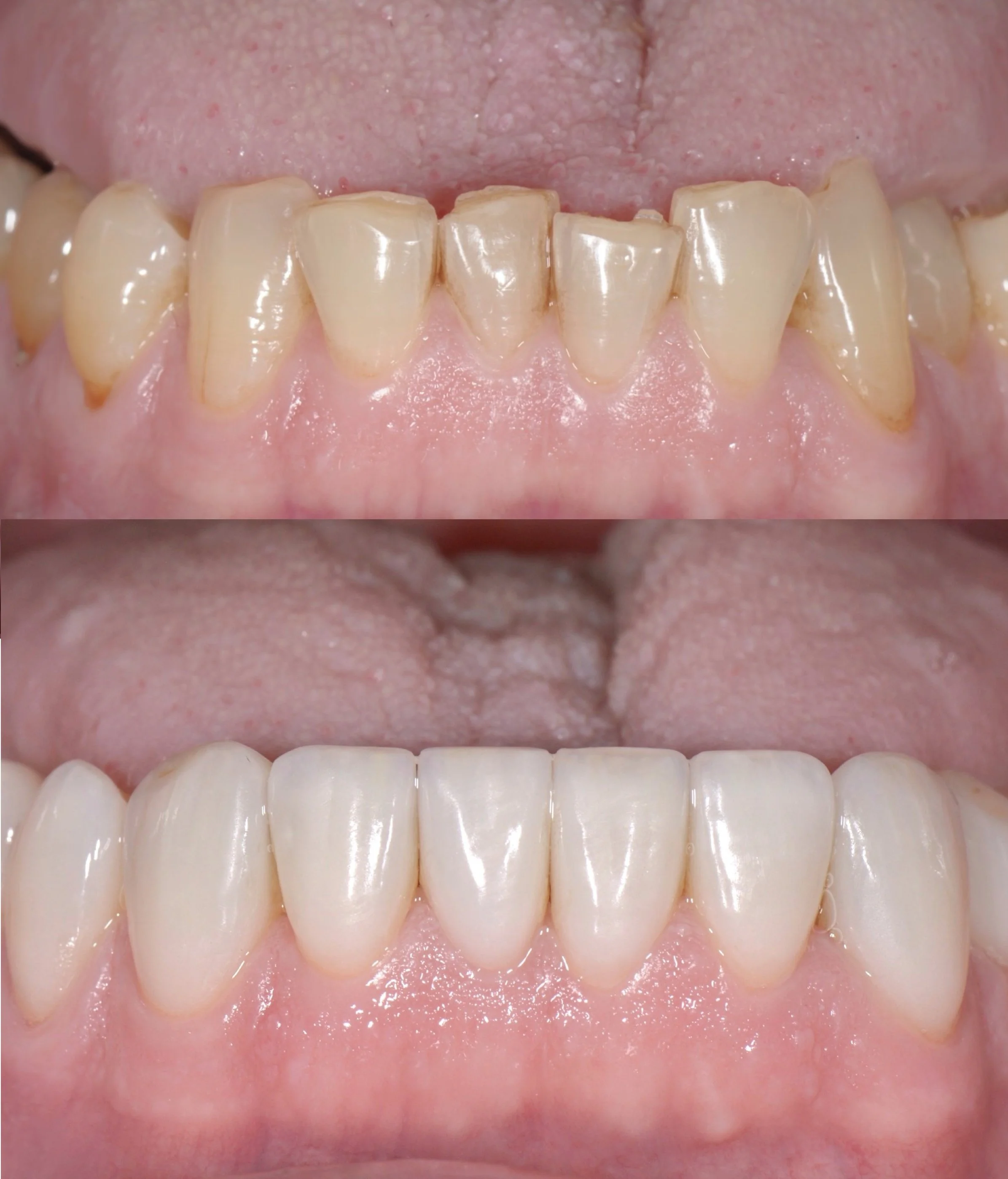 Close-up of a person's teeth before and after dental treatment, showing improved alignment and color.