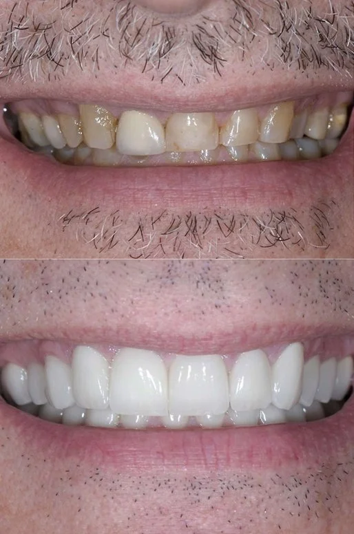 Close-up of a person's mouth showing a before and after comparison of dental improvement. The upper image displays discolored and uneven teeth with visible plaque, while the lower image shows straight, white, and even teeth.