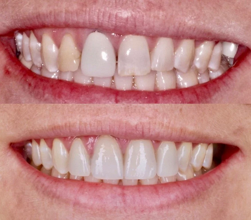 Comparison of teeth before and after whitening, showing significant improvement in color and brightness.