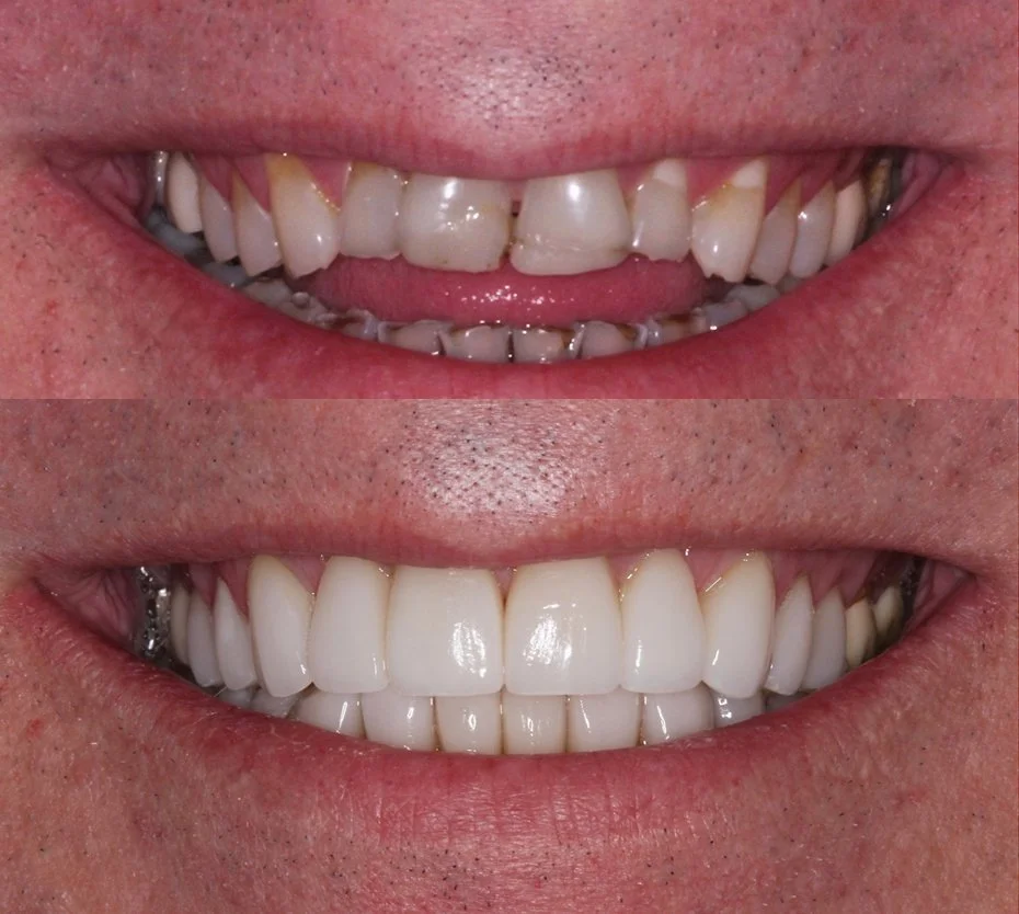 Comparison of a person's teeth before and after dental treatment, showing significant improvement in alignment and whiteness.