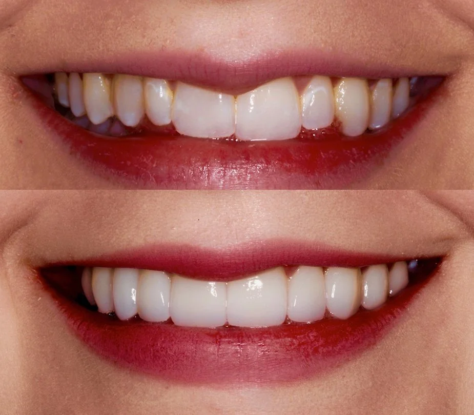 Comparison of teeth before and after whitening, showing an improved bright smile in the bottom image.