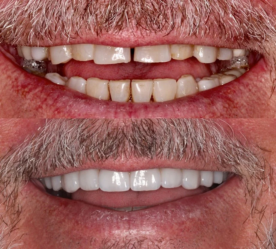 Comparison of a man's teeth before and after dental work, showing improved, whiter, and straighter teeth in the after photo.