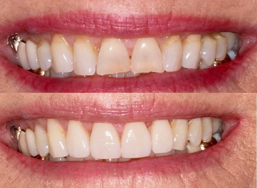 Close-up of a person's smile showing teeth before and after dental whitening, with some dental work visible on the upper and lower teeth.