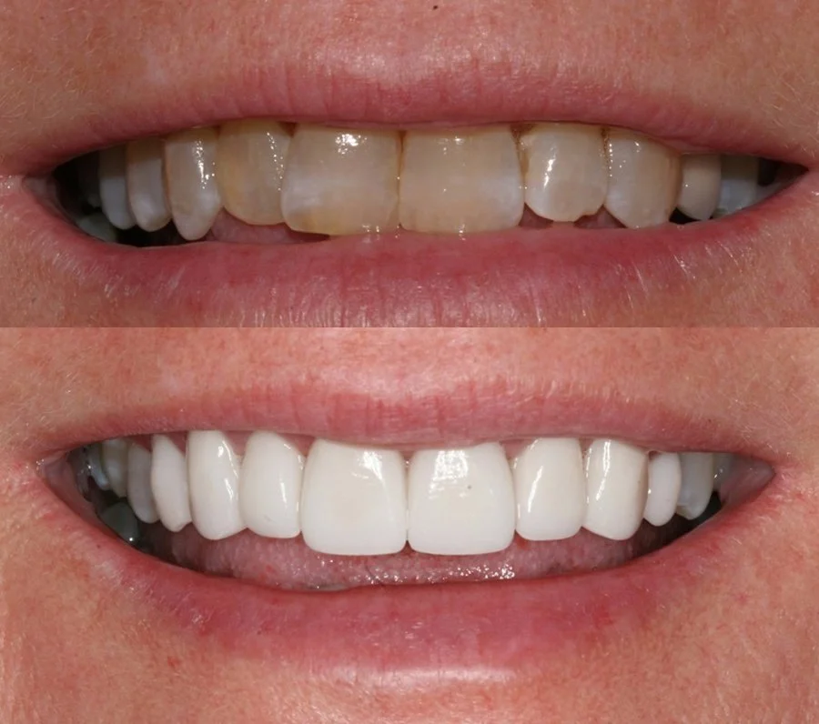Close-up of a person's smile showing a before and after comparison of teeth whitening or dental restorative treatment.