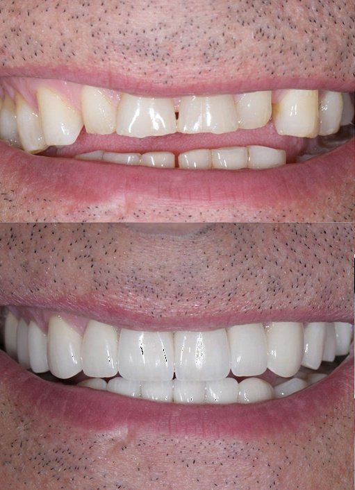 Close-up of a person's smile showing a before-and-after comparison of dental work, with improved, whiter teeth in the after photo.