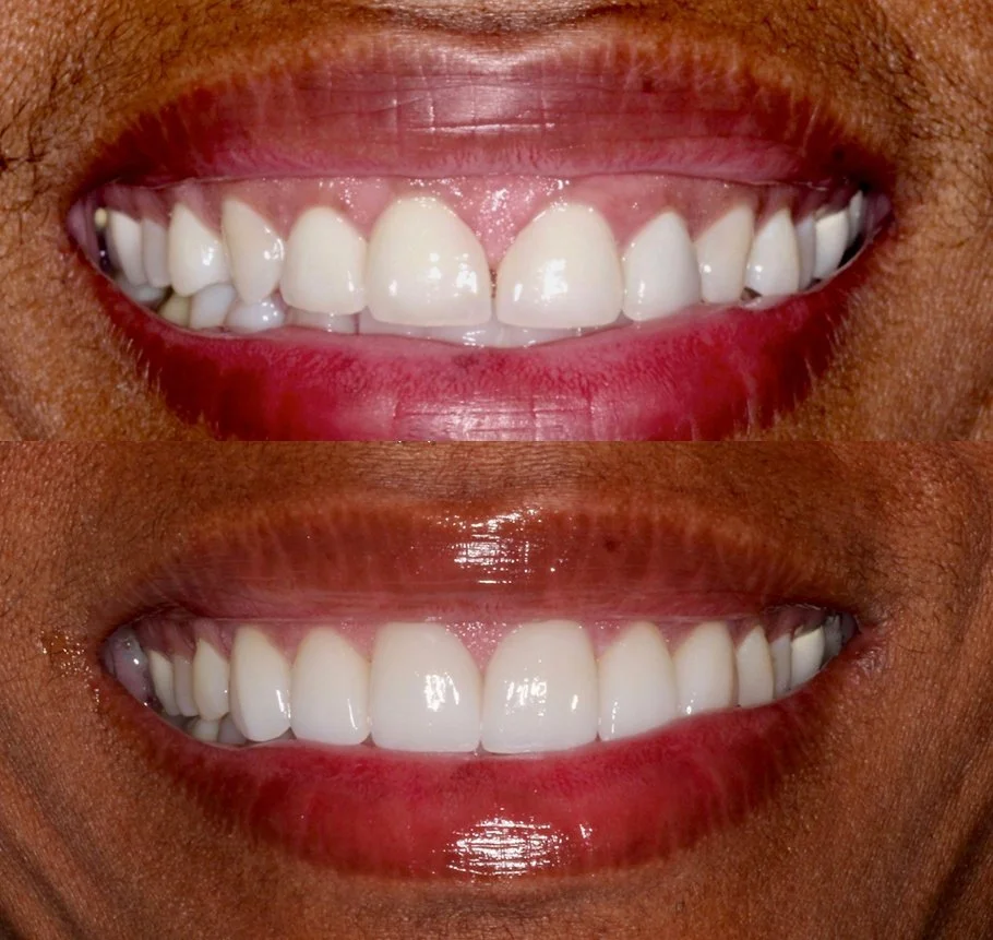 Comparison of a person's teeth before and after dental whitening, showing whiter, more uniform teeth in the lower image.