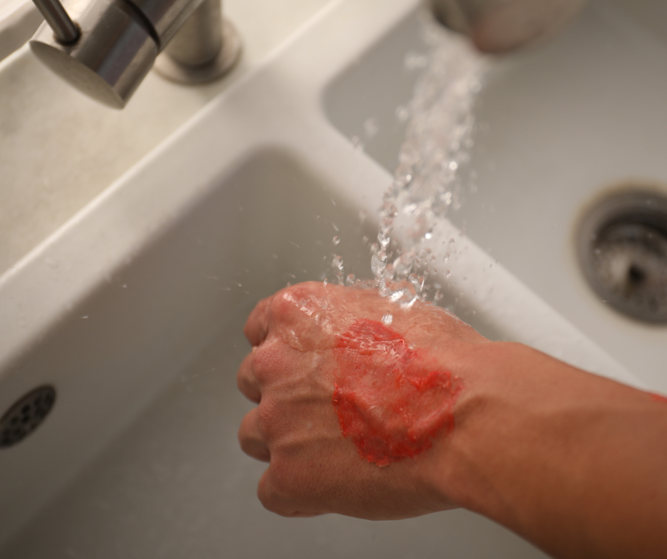 First Aid for Burns &amp; Scalds