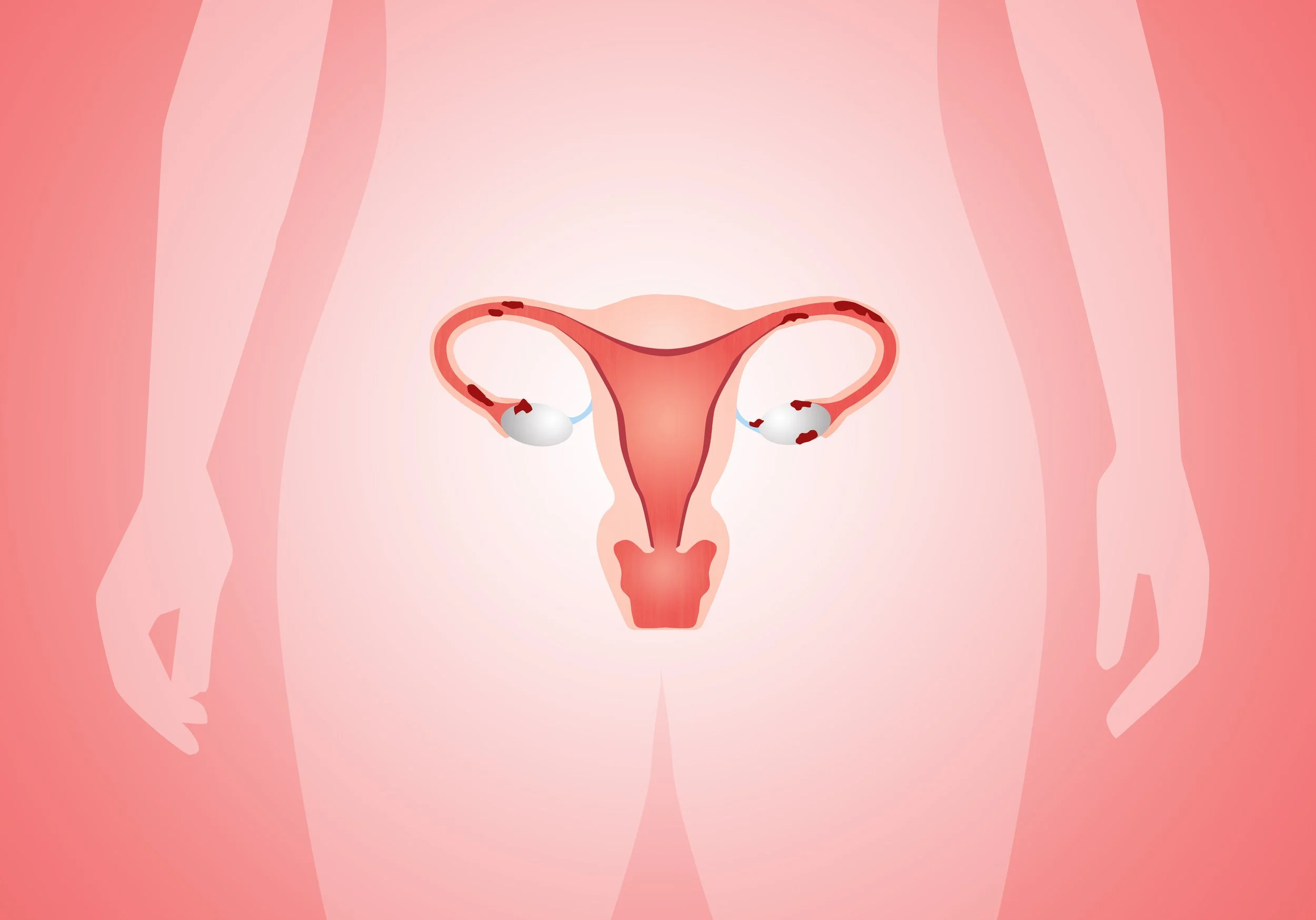 Illustration of the female reproductive system, including the uterus, fallopian tubes, and ovaries.