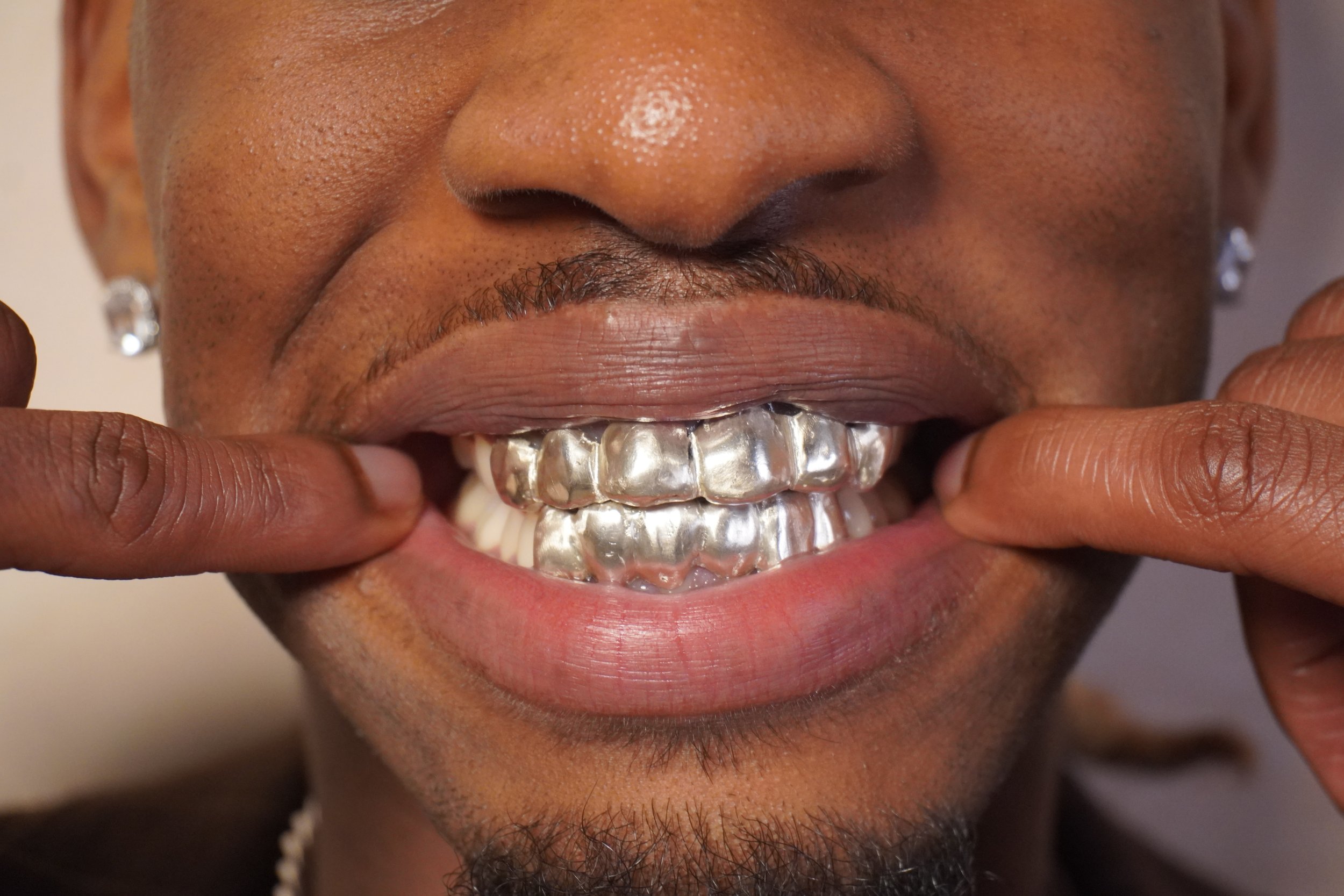 Close-up of a smiling person's face, focusing on their nose, lips, and teeth. The person is revealing their silver grills on their upper teeth with their fingers pulling their lips apart.
