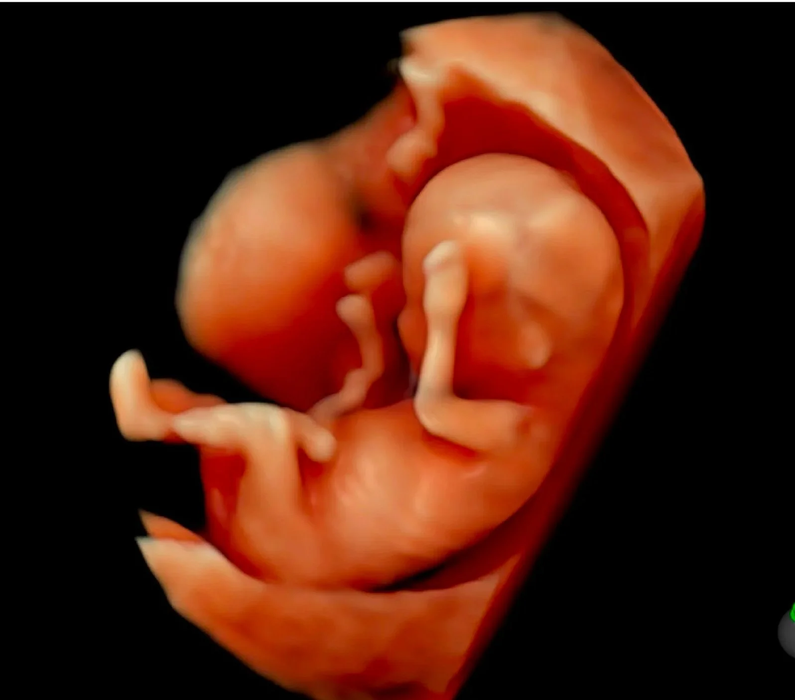 advanced-5d-ultrasound-in-perth