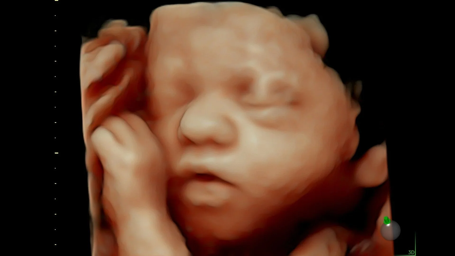 5--fetal-face-with-hdlive.jpg