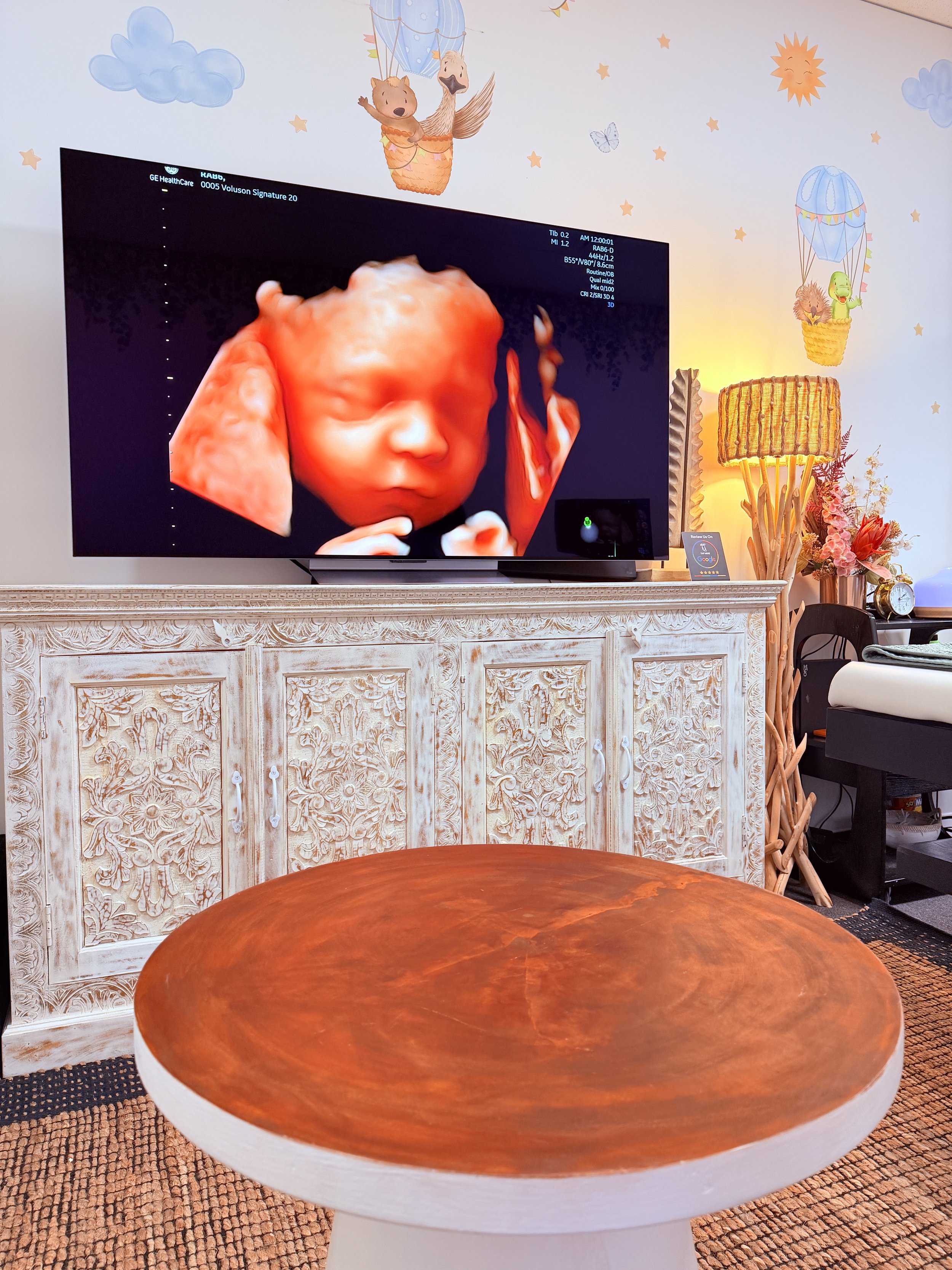 3D Ultrasound Scan