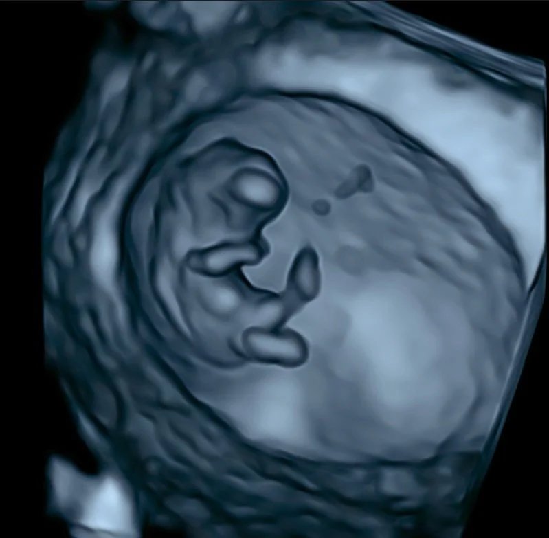 HD-baby-ultrasound-image-perth
