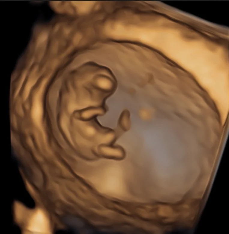 reassurance-pregnancy-scan-perth