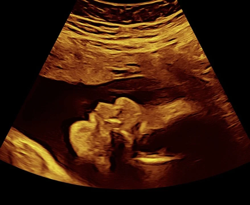 2d-image-of-20-weeks-baby