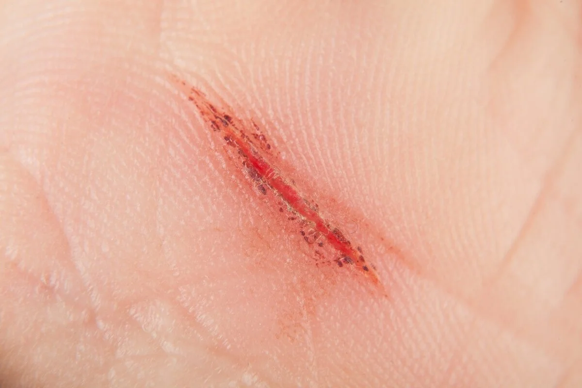 yoga-injury-proliferation-phase-healing-wound-trishcorley