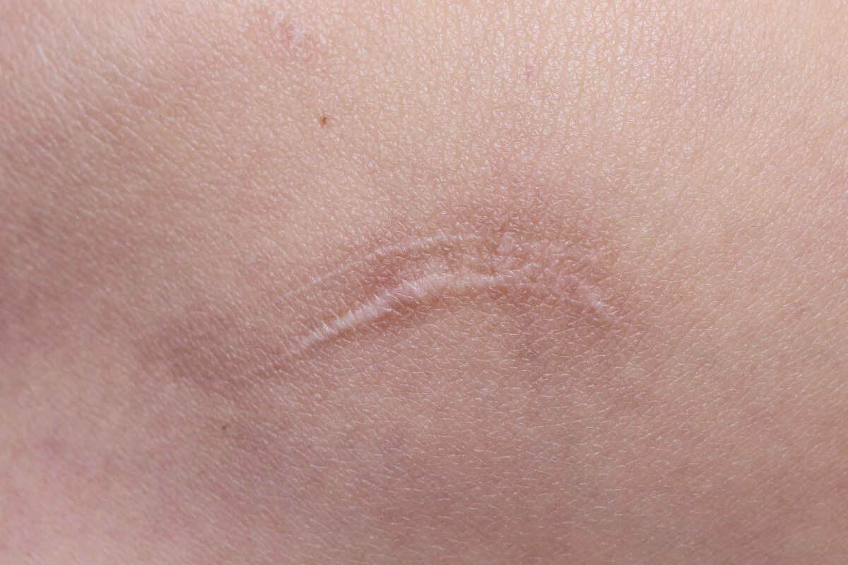 Mature, healed scar tissue during the yoga injury remodeling phase